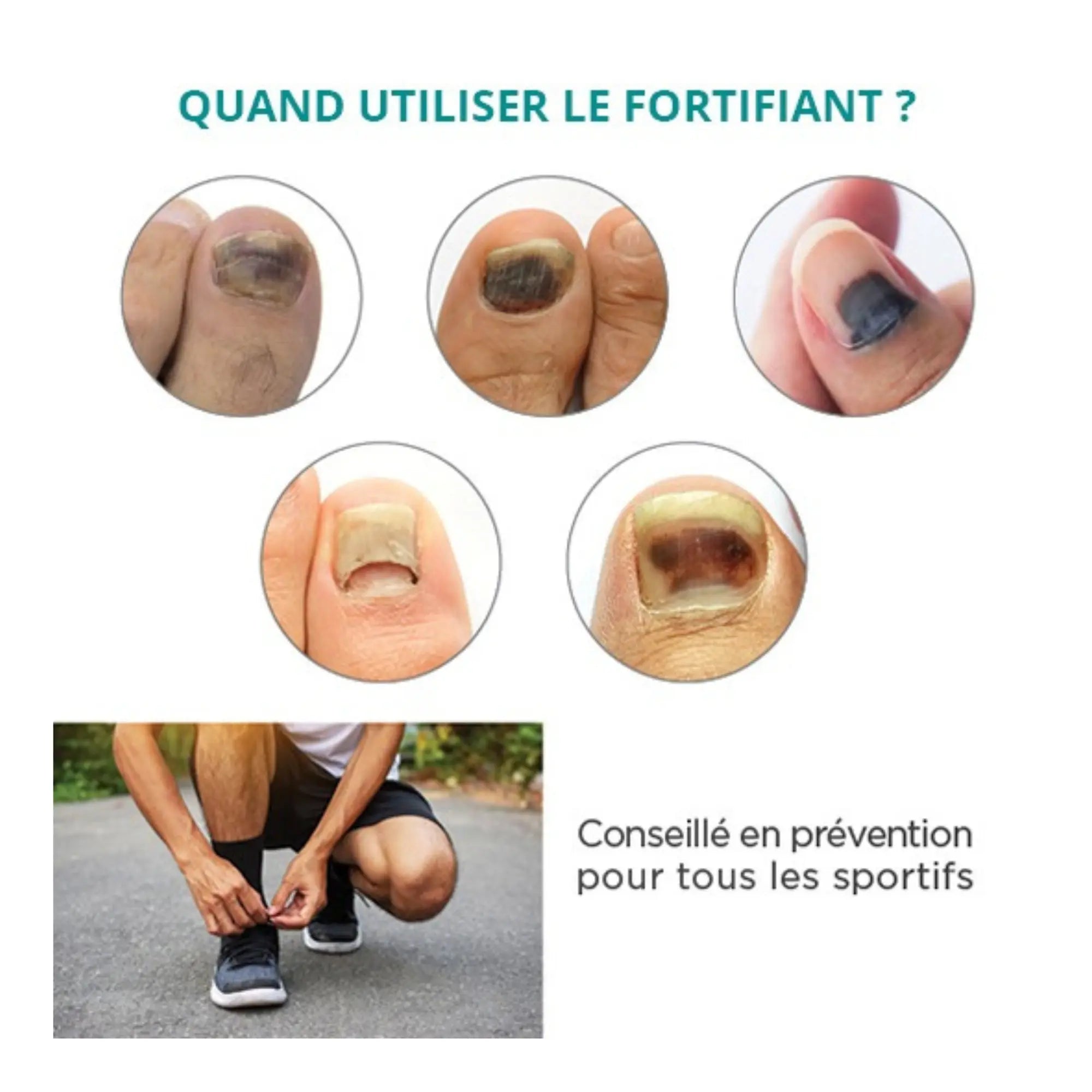Traitement Ongles noirs, traumatisés - 30ml - Fortifiant - Application avec pipette - Poderm Professional - My Podologie